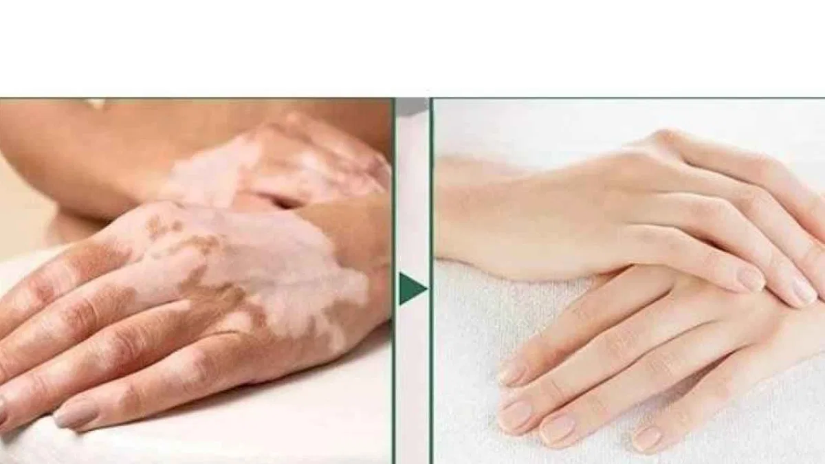 Dünyadaki birçok vitiligo hastası çareyi Bursa’da buluyor
