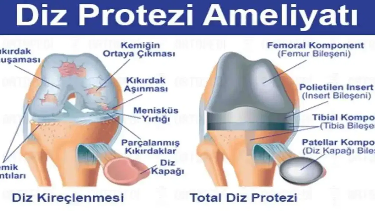 Diz Protezi Ameliyatı: Tüm Yönleriyle Bilmeniz Gerekenler