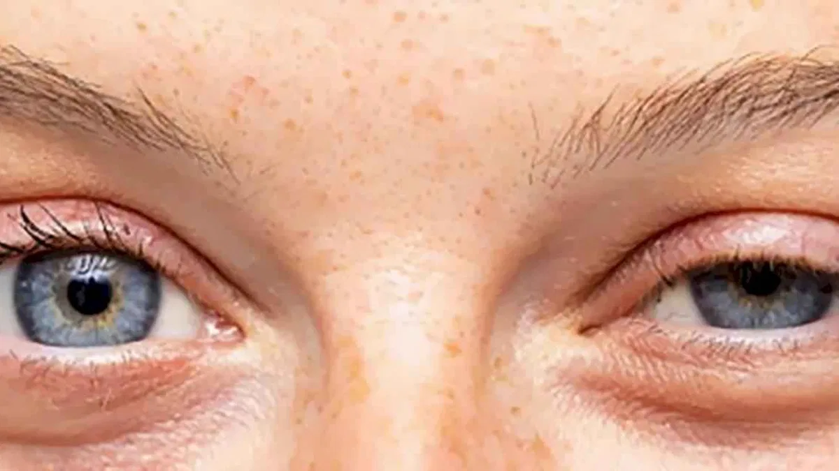 Göz kapak sarkması çocukları da etkiliyor!