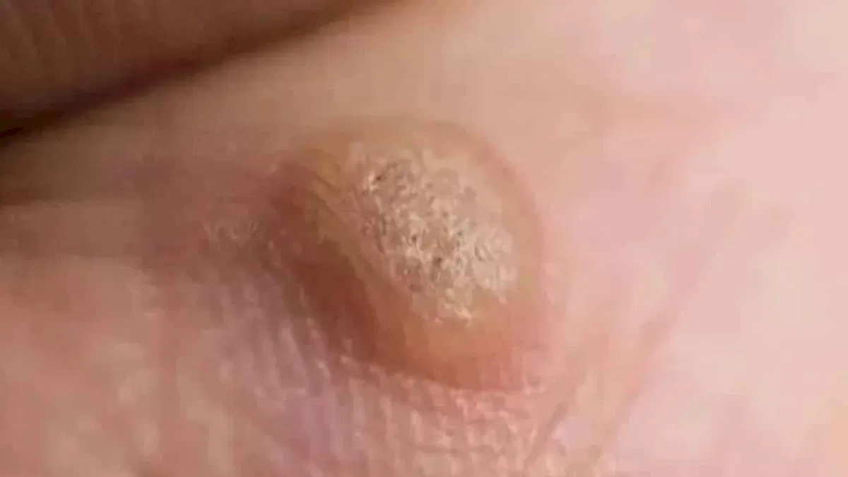 Ayakta ve genital bölgede çıkan siğile dikkat!