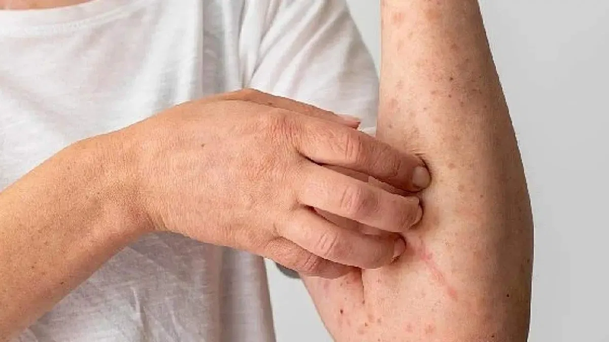 1 Ekim Dünya Ürtiker Günü: Gereksiz Besin Diyetleri Ürtikeri Tetikliyor