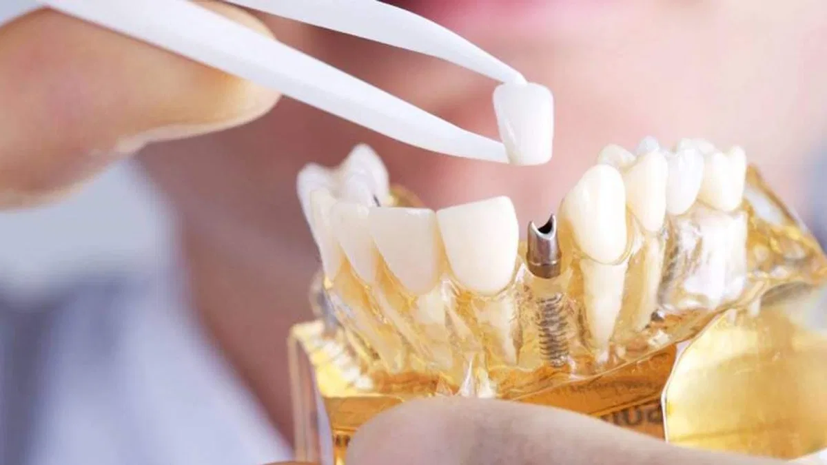 Türkiye’de implant fiyatları